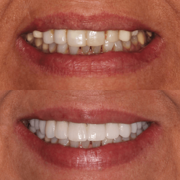 premium, custom dental crowns at kakaris family dentistry