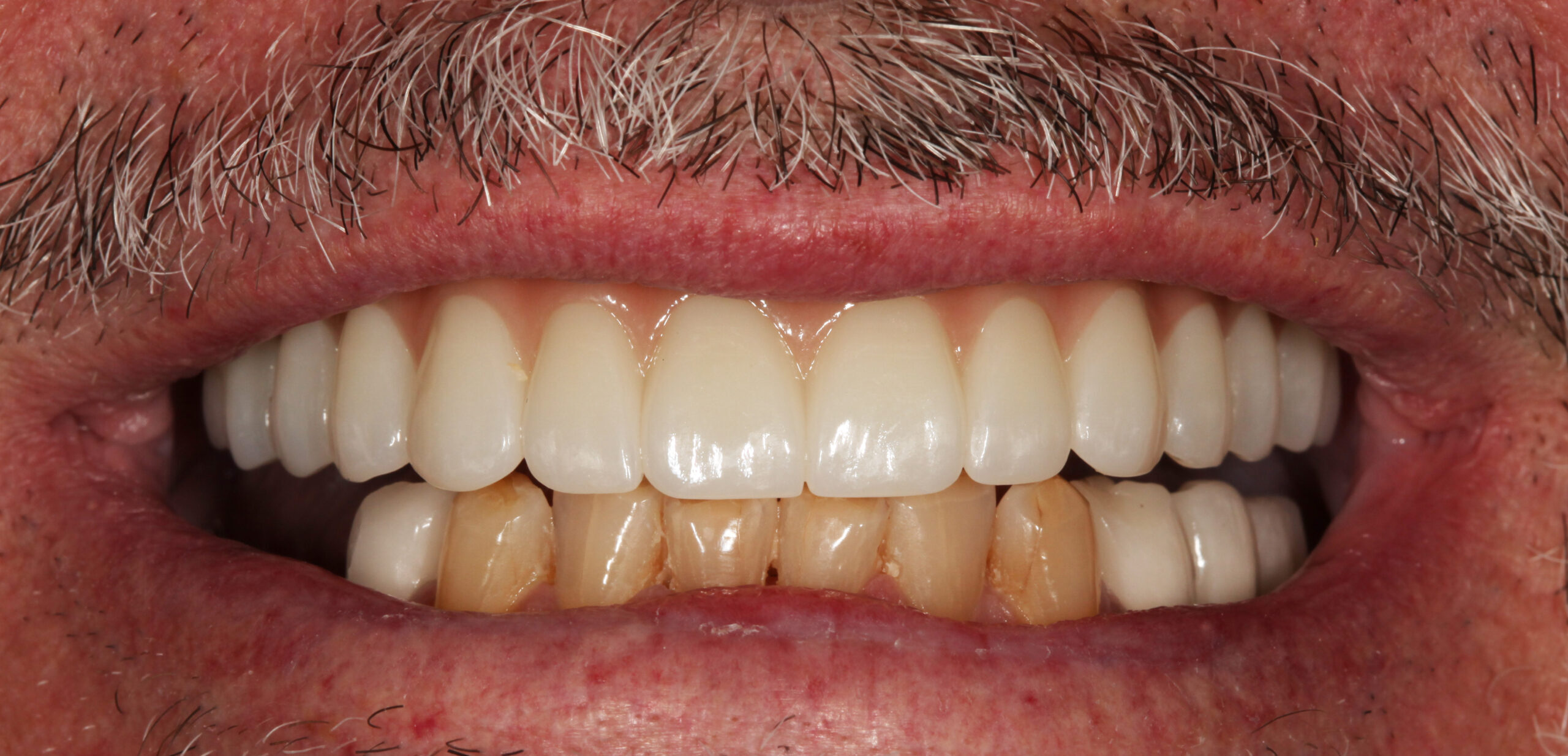 After photo of patient prior to all-on-x treatment