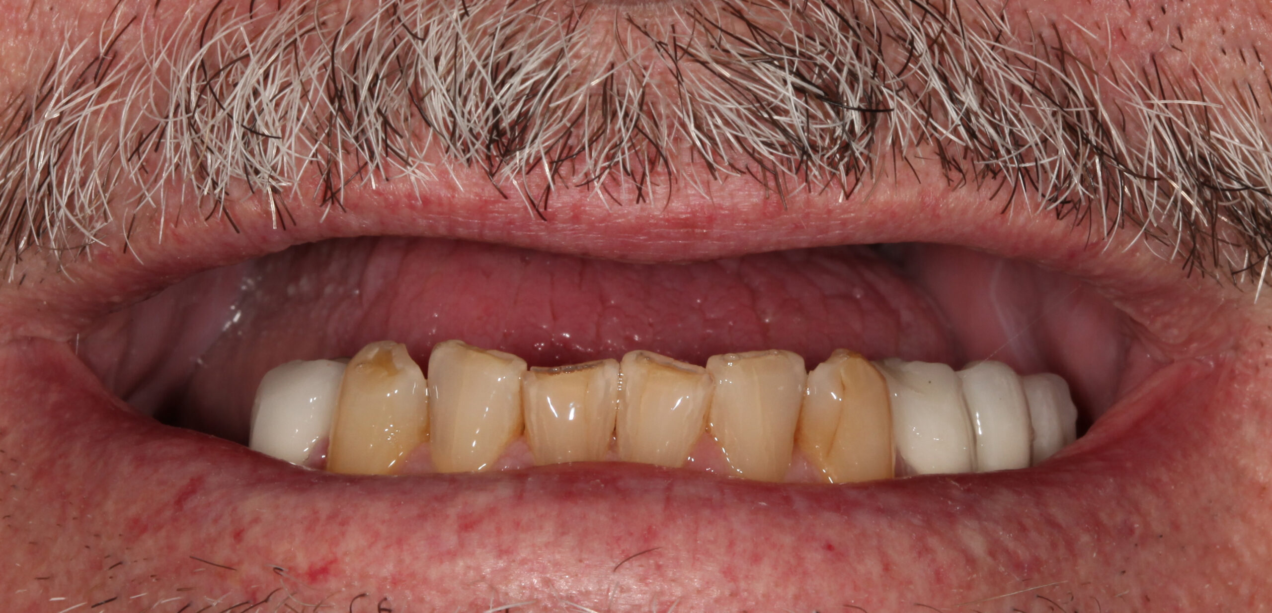 Before photo of patient prior to all-on-x treatment