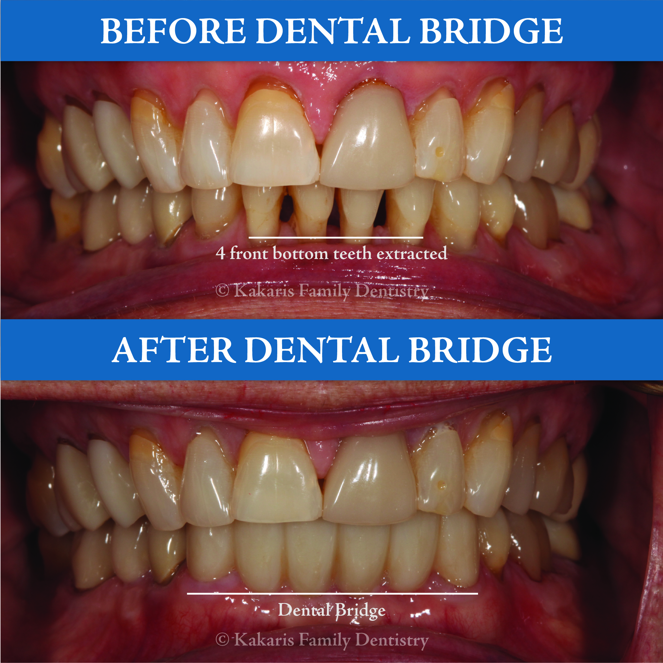 dental bridges