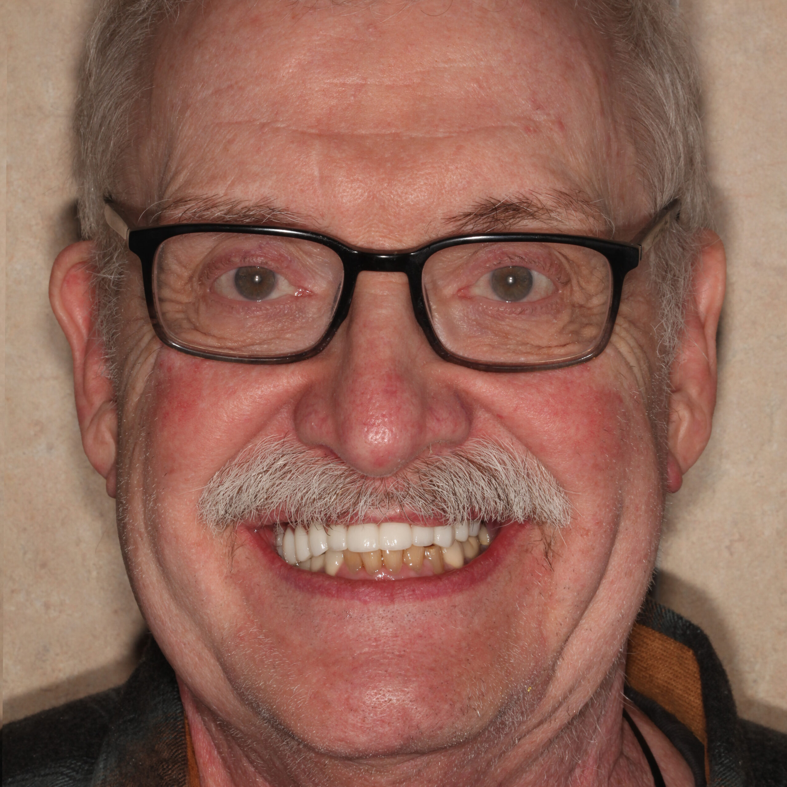 Patient after all-on-x treatment