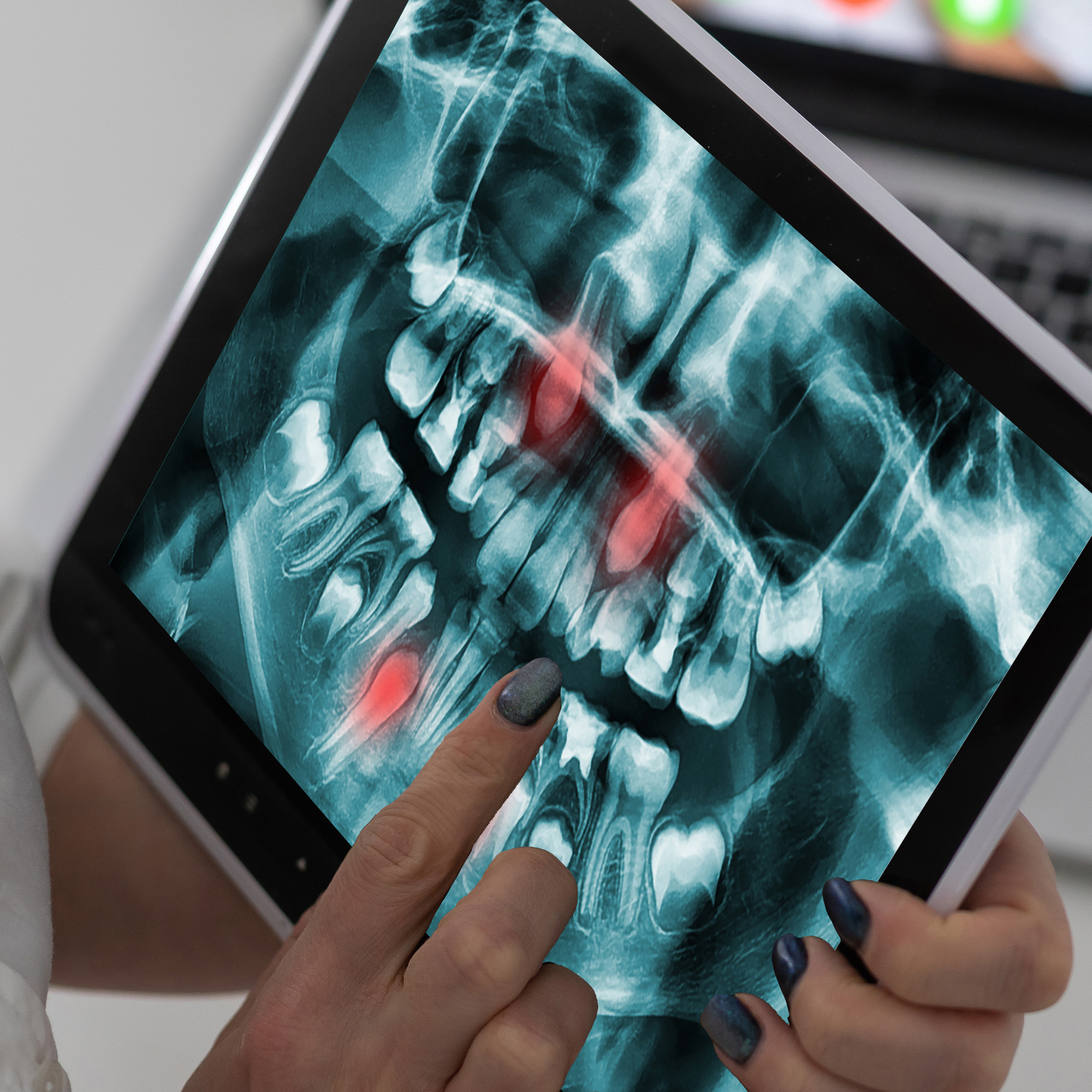 an emergency digital xray showing cause of toothache