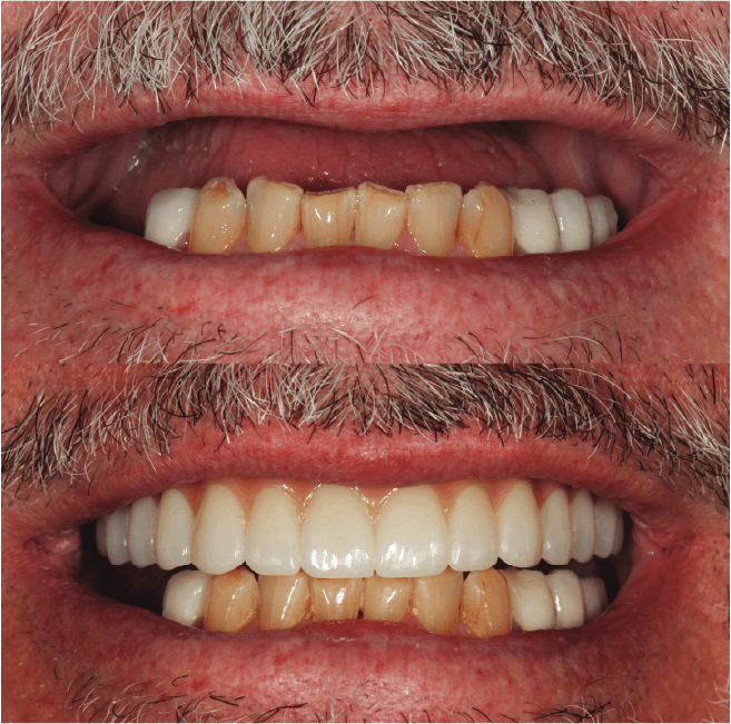 Can I get Dental Implants All on 4