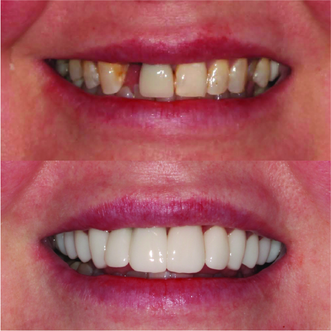 Can I get Dental Implants Single tooth implant