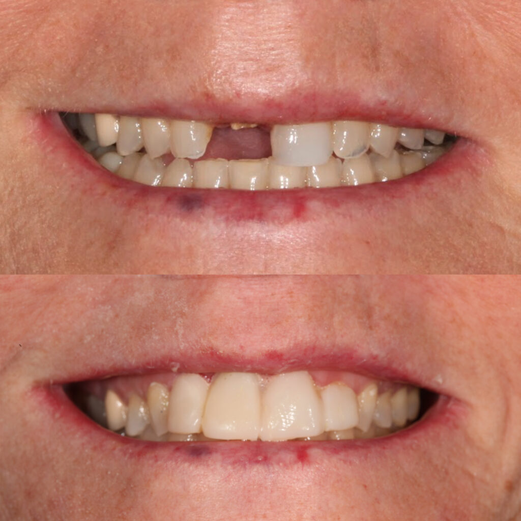 Can I get Dental Impants?