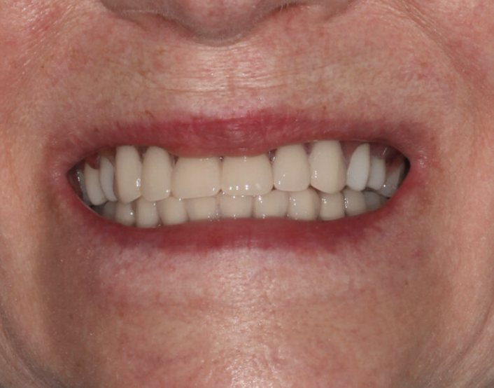 Pros and Cons of Dental Implants After