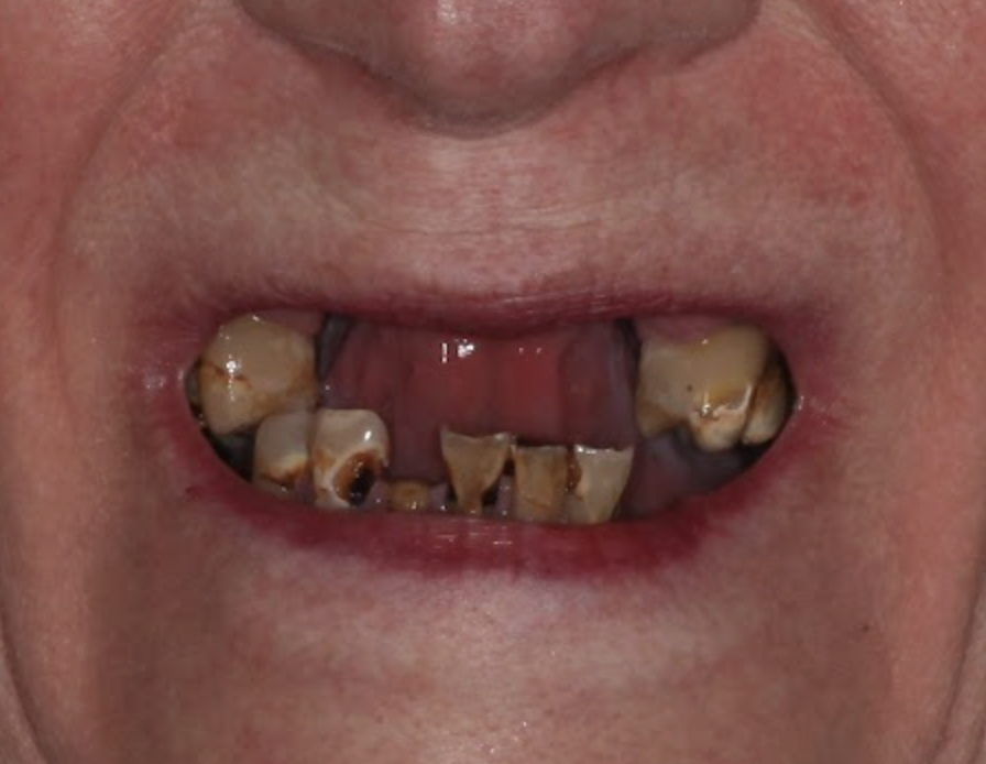 Pros and Cons of Dental Implants Before