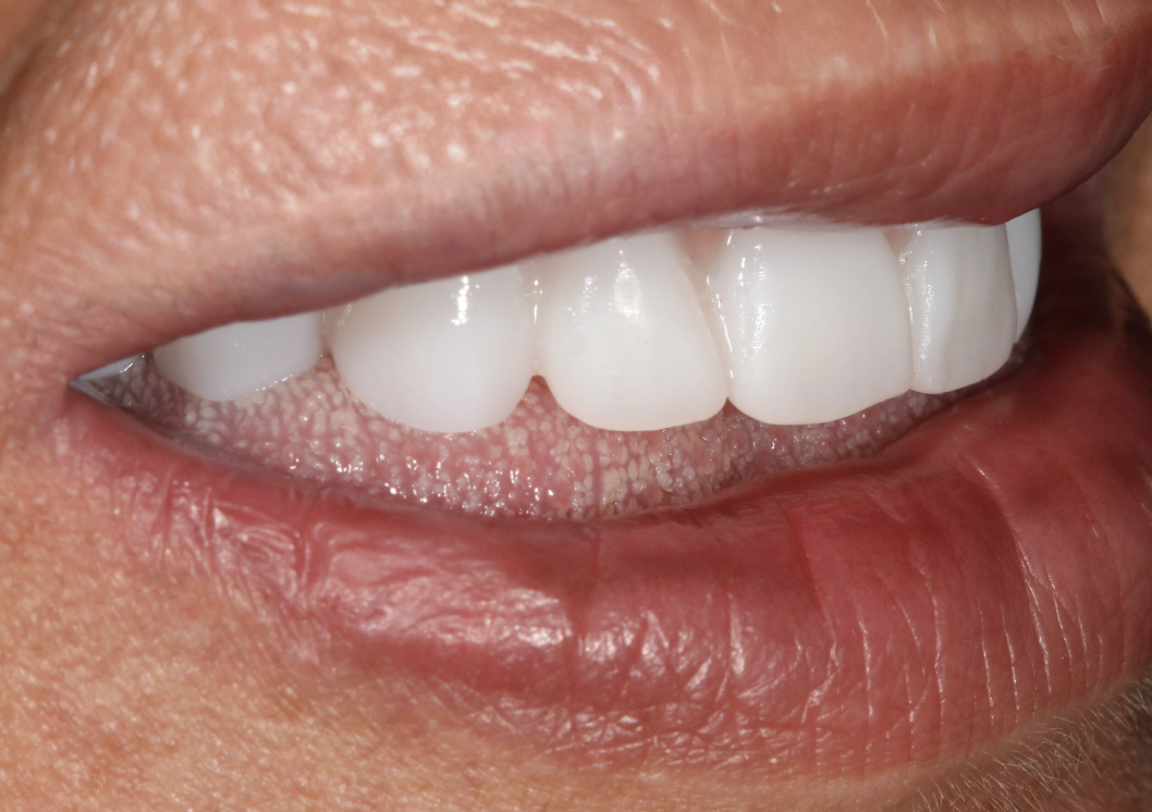 Same Day Denture Repair