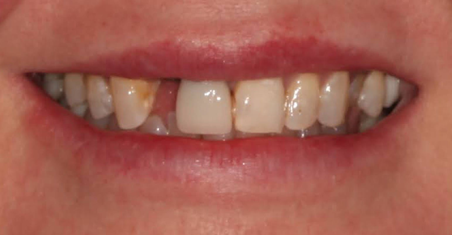 best way to replace a missing tooth