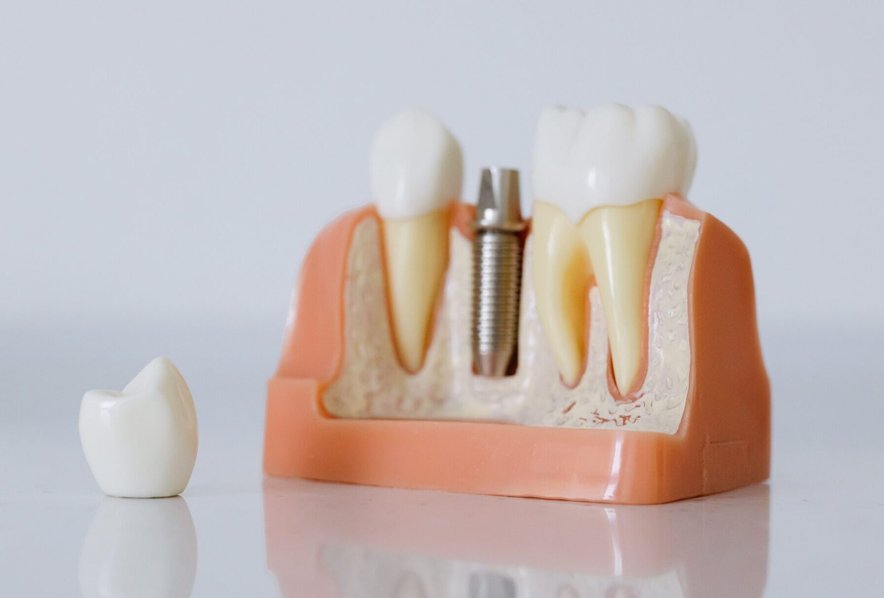are dental implants worth it?