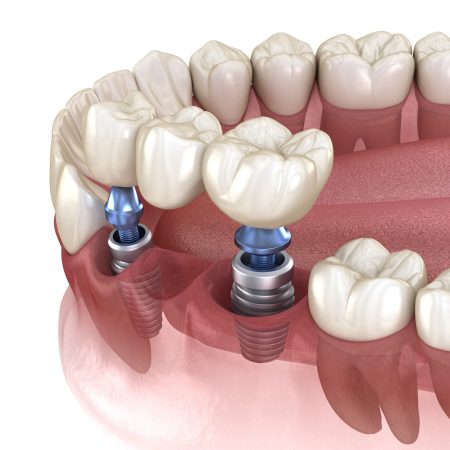 Dental bridge supported by implants. Medically accurate 3D illustration of human teeth and dentures concept