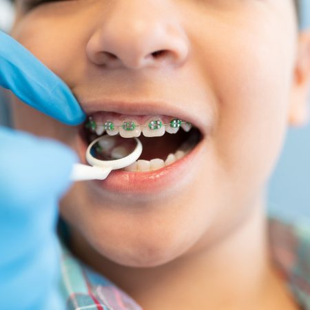 Closeup of orthodontist examining boy wearing braces with dental mirror